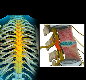 Thoracic Nerve Compression Images