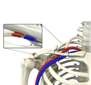Thoracic Outlet Syndrome Images