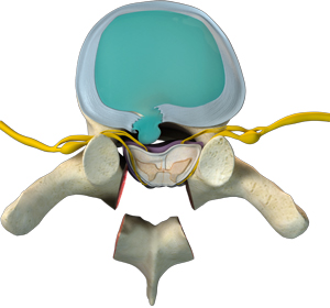 Thoracic Spine Decompression Images