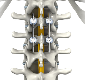 Thoracic Spine Fusion Images