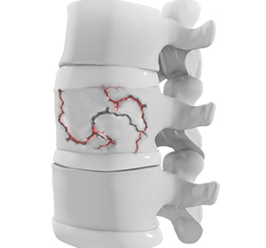 Thoracic Spine Trauma Surgery Images