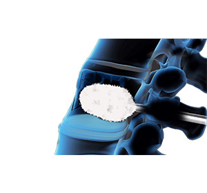 Vertebroplasty Images