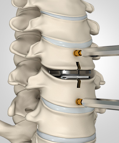 Artificial Disc
                                            Replacement Images