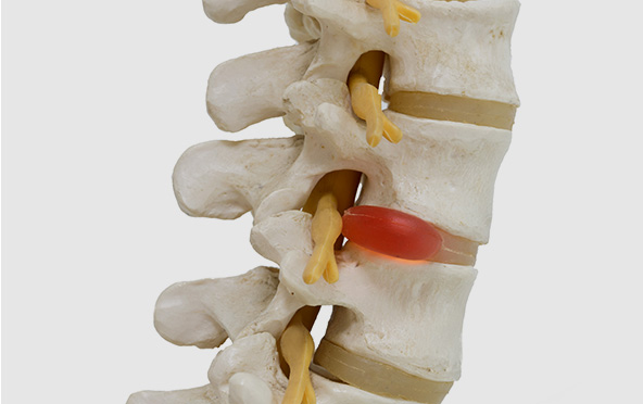 Cervical Disc Hernation