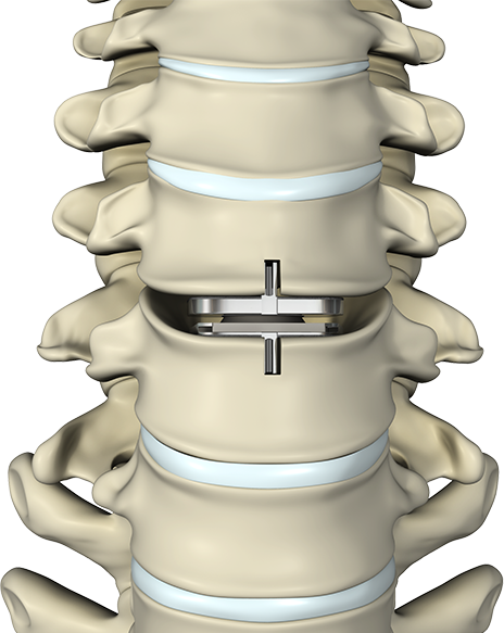Motion Preservation Surgery Images