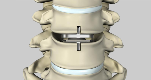 Lumbar Images