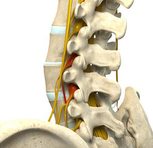 Motion Preservation Surgery Indications Images