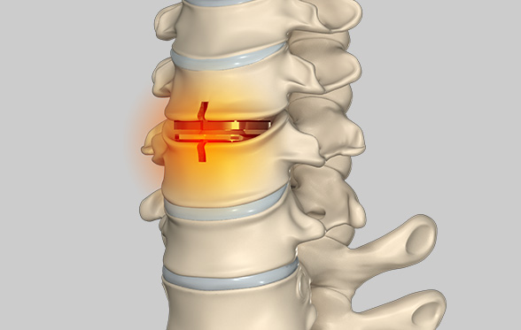 Revision Spine Surgery Images