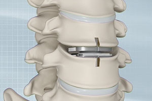 Artificial Cervical Disc Replacement - Educational Picture