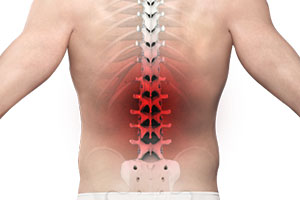 Back Pain - Educational Picture