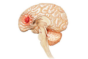Benign Brain Tumors - Educational Picture