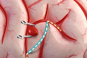 Brain Aneurysm Clipping and Coiling - Educational Picture