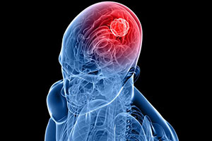 Brain Tumor Surgery - Educational Picture