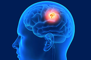 Brain Tumor - Educational Picture