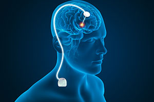 Deep Brain Stimulation - Educational Picture