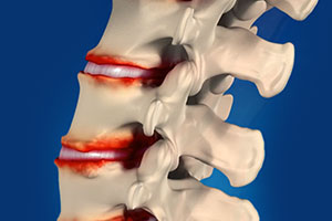 Degenerative Spinal Conditions - Educational Picture