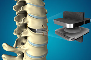 Disc Arthroplasty - Educational Picture