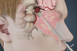 Endoscopic Brain Surgery - Educational Picture