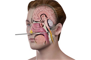 Endoscopic Odontoidectomy - Educational Picture