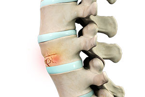 Fractures of the Spine - Educational Picture