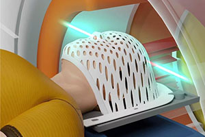 Gamma Knife Radiosurgery - Educational Picture