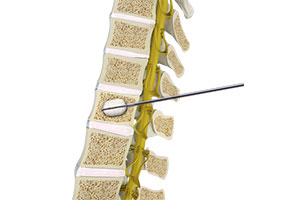 Kyphoplasty - Educational Picture