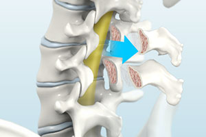 Laminectomy - Educational Picture