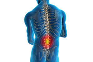 Low Back Pain - Educational Picture