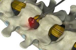 Microdiscectomy - Educational Picture