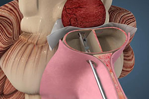 Minimally Invasive Endoscopic Neurosurgery - Educational Picture