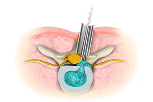 Minimally Invasive Spine Surgery - Educational Picture