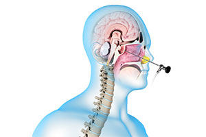 Skull Base Surgery - Educational Picture
