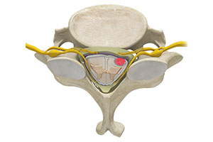 Spinal Cord Tumors - Educational Picture