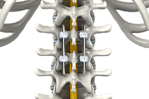 Spinal Fusion - Educational Picture