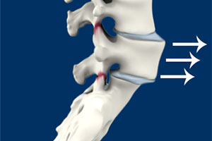 Spinal Instability - Educational Picture