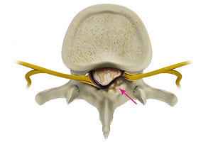 Spinal Stenosis- Educational Picture