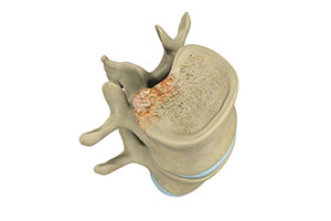 Spinal Tumor Surgery - Educational Picture