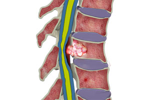 Spinal Tumors - Educational Picture
