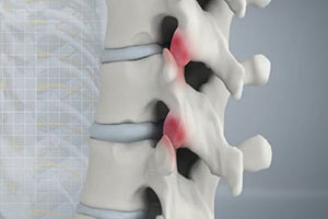 Spine Arthritis - Educational Picture