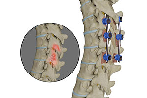 Spine Trauma Surgery - Educational Picture