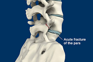 Spondylolysis - Educational Picture