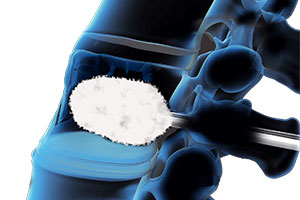Vertebroplasty - Educational Picture