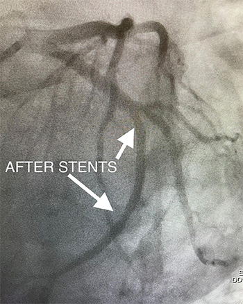 HeartCare4life, Dr. Vimal Nanavati, Board Certified in Cardiology and Interventional Cardiology After Stent