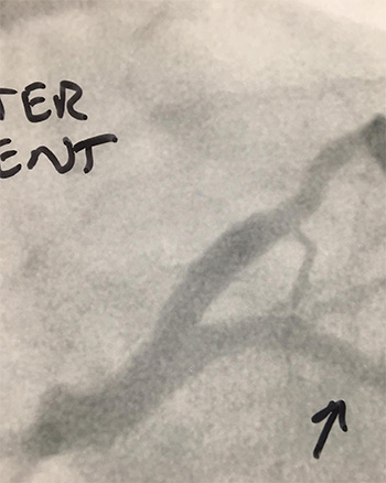 HeartCare4life, Dr. Vimal Nanavati, Board Certified in Cardiology and Interventional Cardiology After Stent