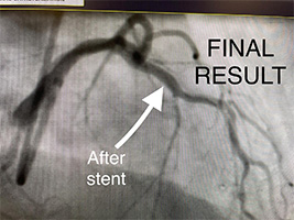 HeartCare4life, Dr. Vimal Nanavati, Board Certified in Cardiology and Interventional Cardiology After Stent Result.jpg
