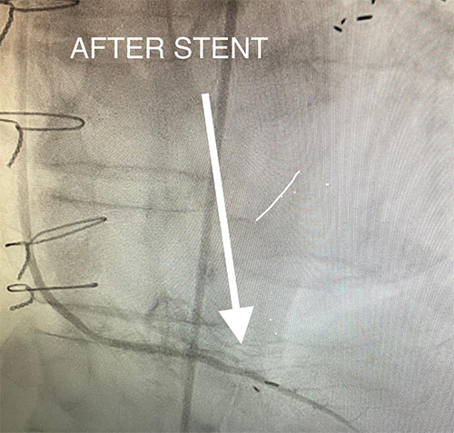 HeartCare4life, Dr. Vimal Nanavati, Board Certified in Cardiology and Interventional Cardiology Anastamotis - After