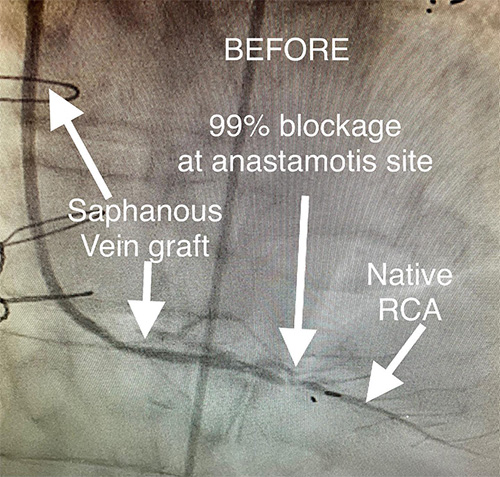 HeartCare4life, Dr. Vimal Nanavati, Board Certified in Cardiology and Interventional Cardiology Anastamotis - Before