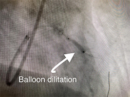 HeartCare4life, Dr. Vimal Nanavati, Board Certified in Cardiology and Interventional Cardiology Balloon Dilitation