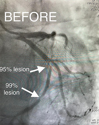 HeartCare4life, Dr. Vimal Nanavati, Board Certified in Cardiology and Interventional Before Stent