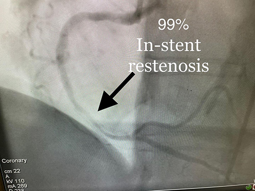 HeartCare4life, Dr. Vimal Nanavati, Board Certified in Cardiology and Interventional In Stent Restenosis